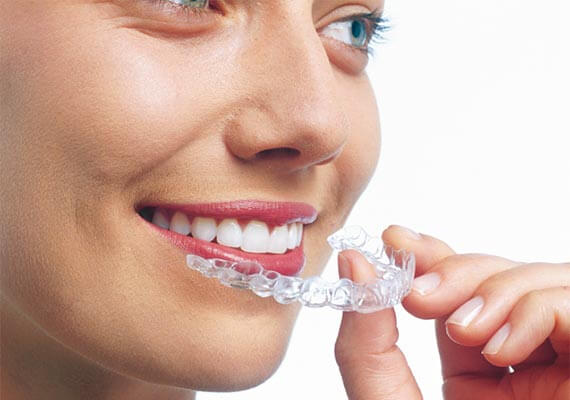 Alignertechnik – Invisalign